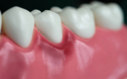 Diş Eti İltihabı Nedenleri ve Tedavi Yöntemleri